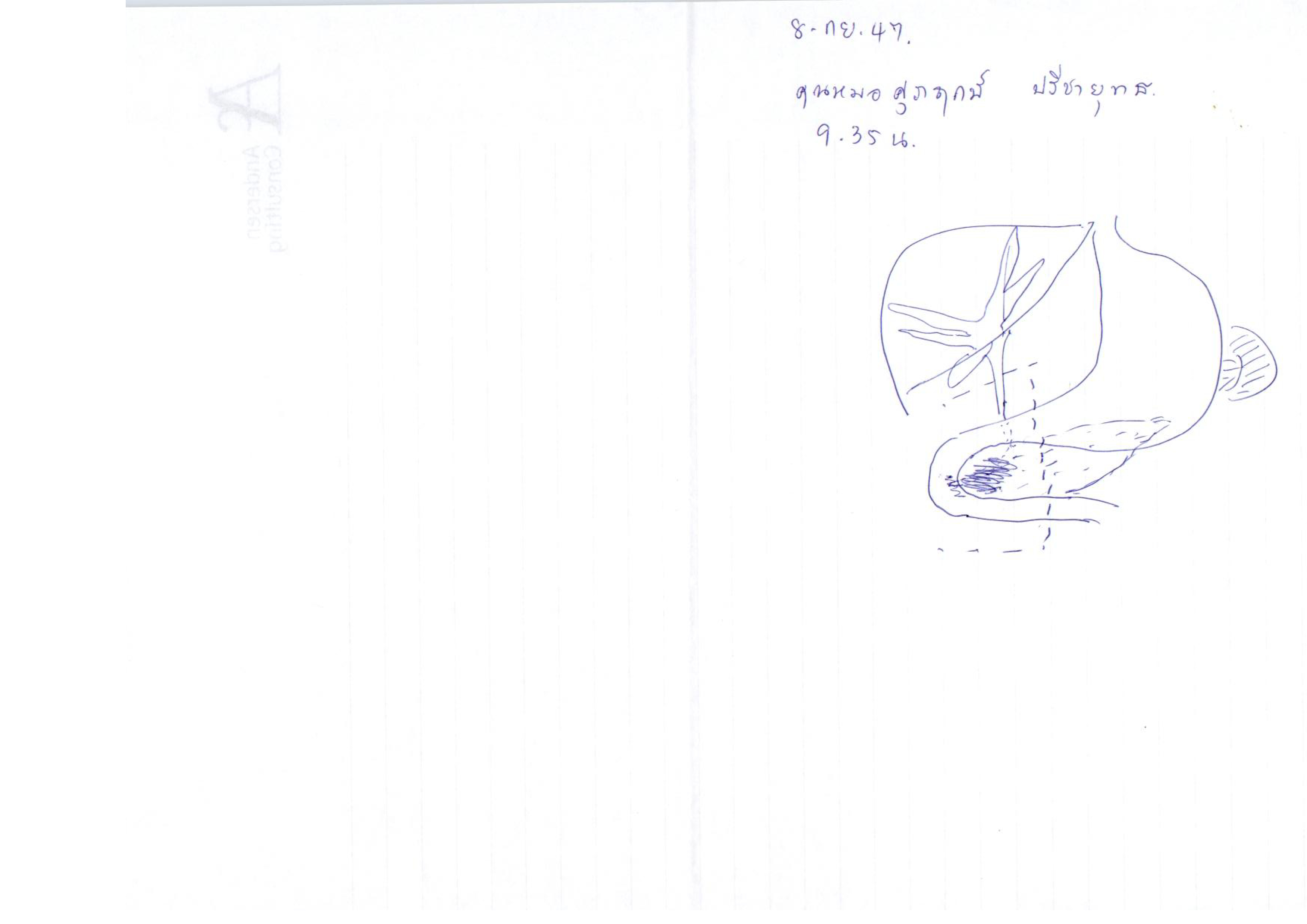 ภาพวาดตำแหน่งก้อนเนื้อ (มะเร็งตับ) และการรักษา (ผ่าตัด)